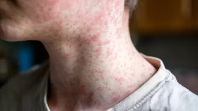 Measles Virus Adobe-Stock