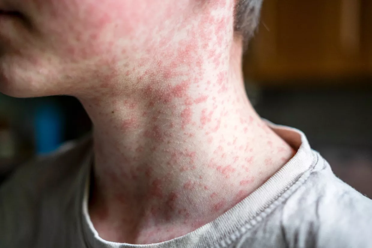 Measles Virus Adobe-Stock